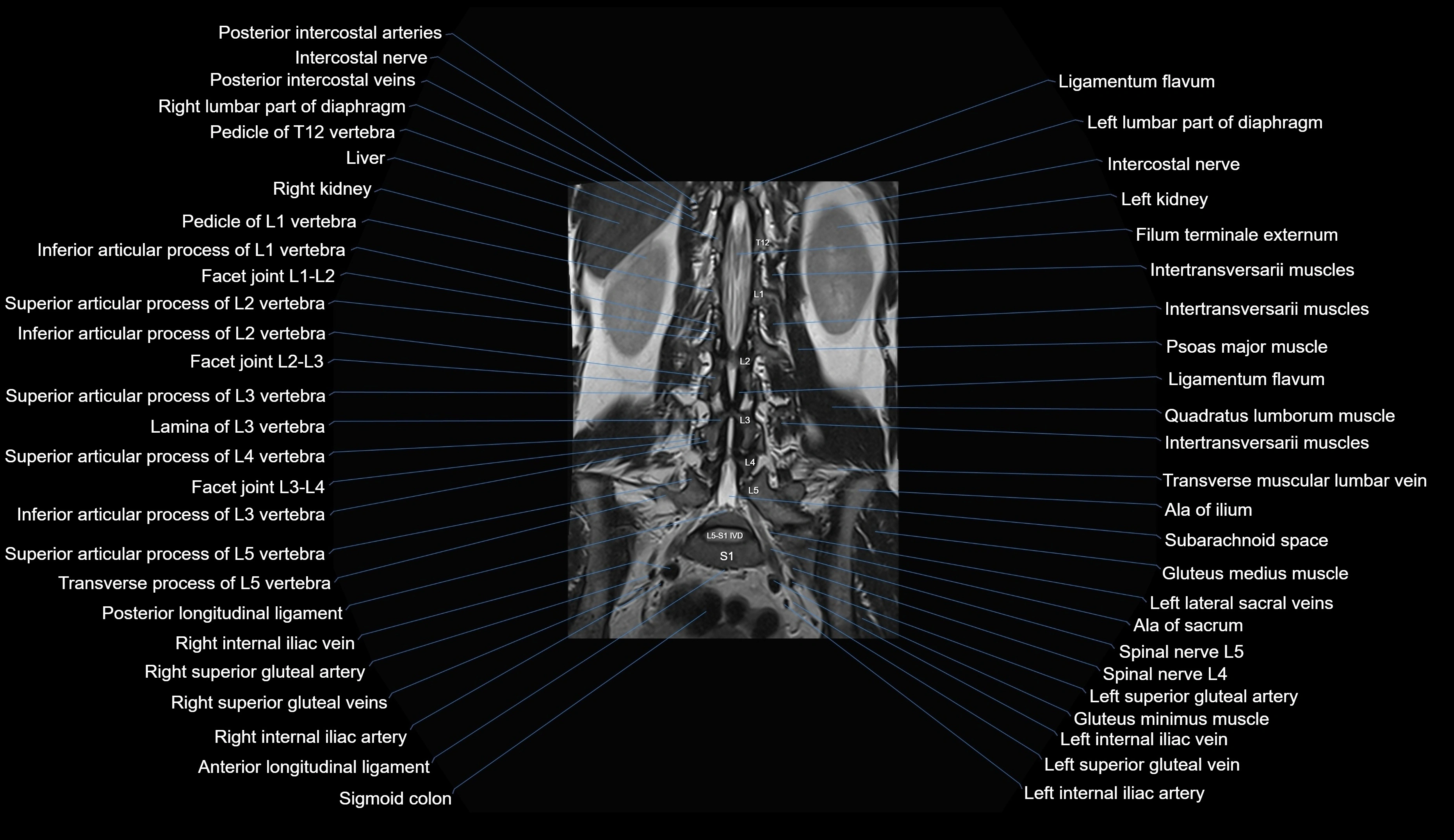 MRI lumbar spine coronal cross sectional anatomy 3T radiology  image-img-00001-00021.webp